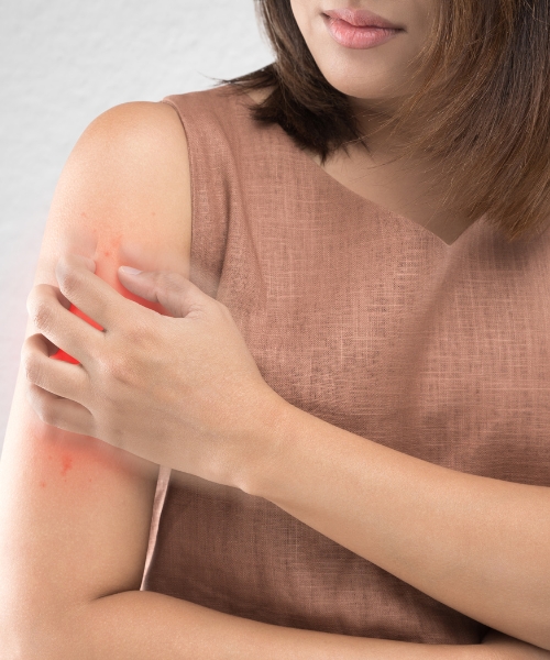 Psoriasis