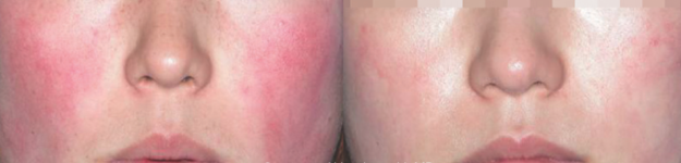 RosaceabeforeandafterbyM22LaserPhotorejuvenationcourtesyof YuanhongLiMD