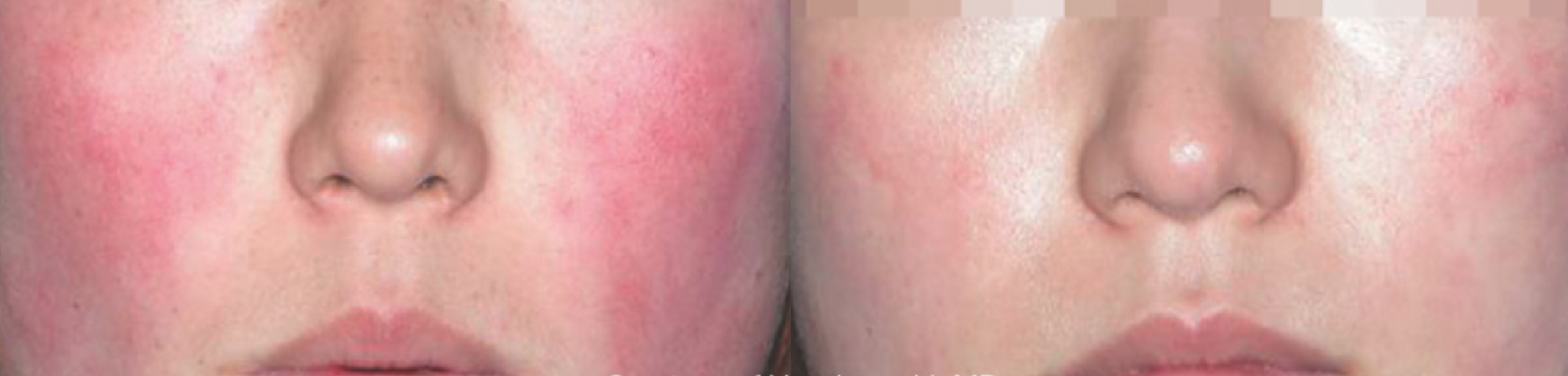 RosaceabeforeandafterbyM22LaserPhotorejuvenationcourtesyof YuanhongLiMD